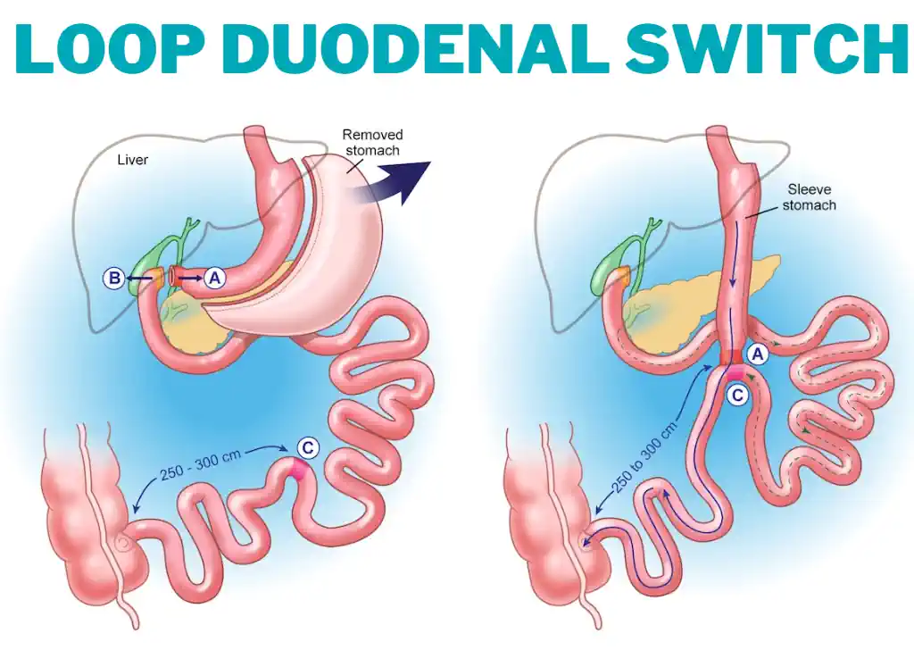 Loop Duodenal Switch – What is it?